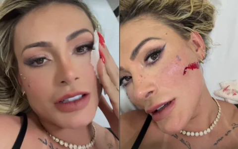 Imagem do post Saiba o que Andressa Urach vai fazer com a cicatriz do rosto