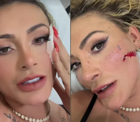 Imagem do post Saiba o que Andressa Urach vai fazer com a cicatriz do rosto