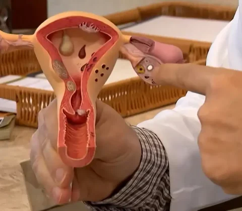 Imagem do post Endometriose: conheça os sintomas e saiba como tratar a doença