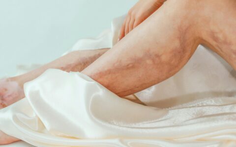 Imagem do post Trombose x Varizes: Entenda a diferença, sintomas e riscos