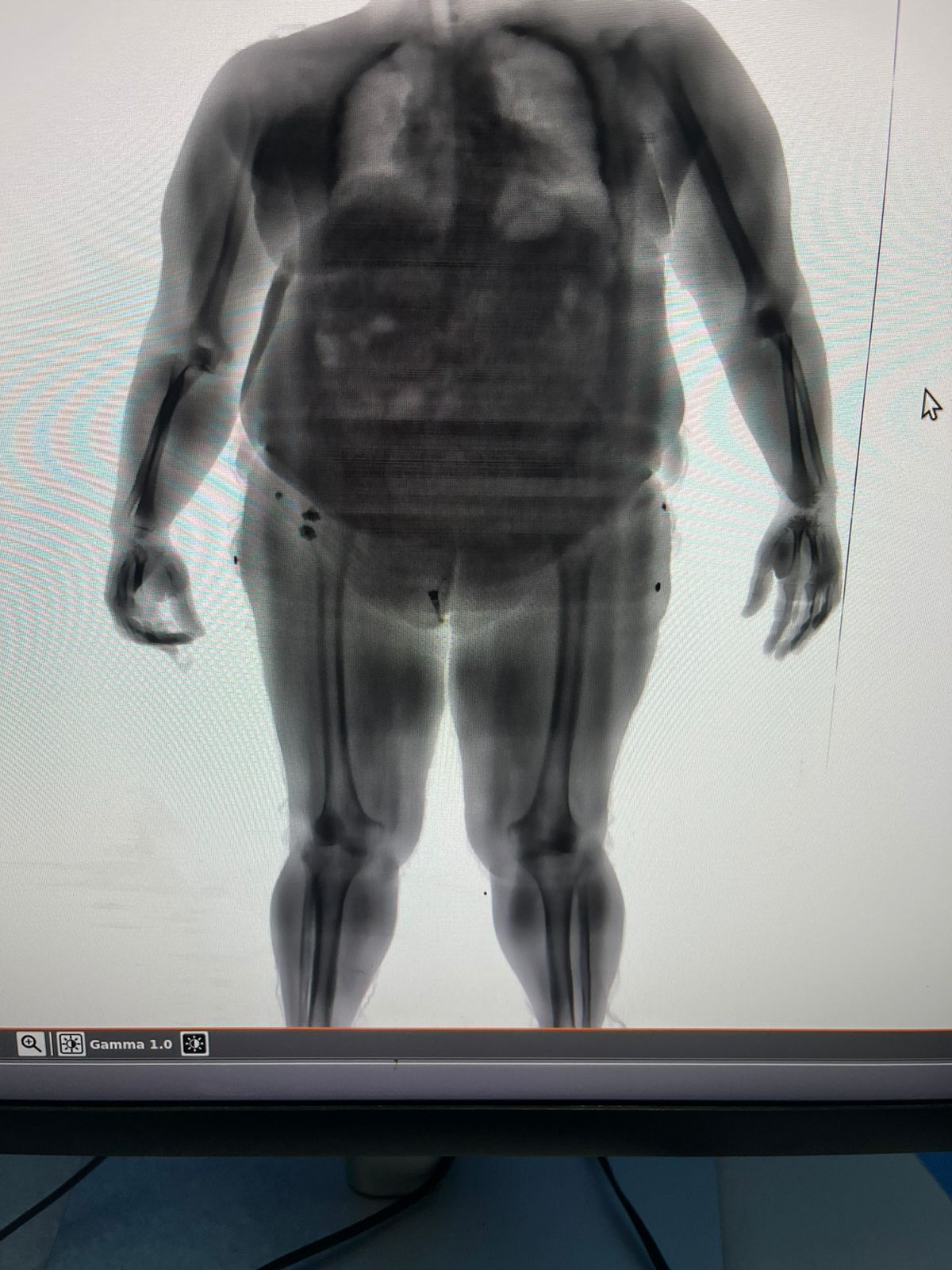 BodyScan flagra mulher tentando entrar com drogas no Conjunto Penal