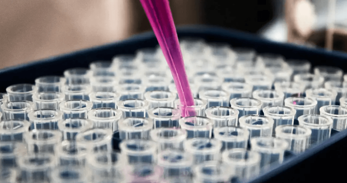 Avanço: Exame de sangue pode diagnosticar Alzheimer