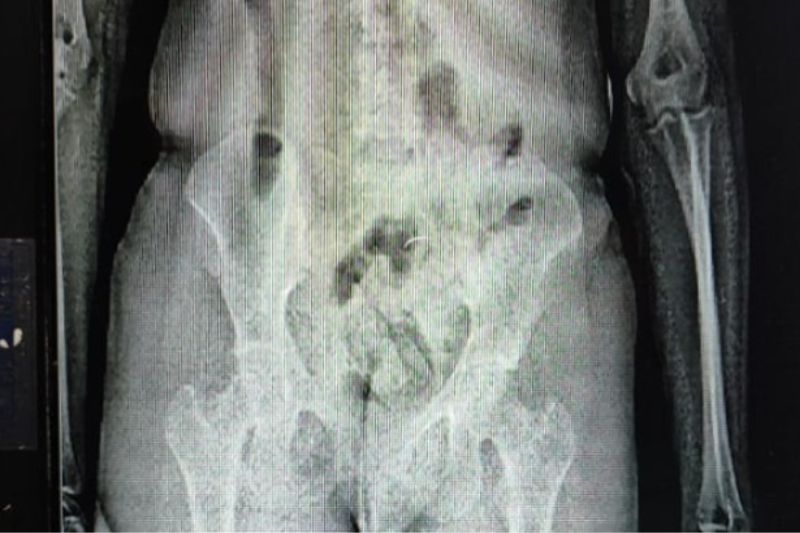 Eunápolis: mulher tenta entrar em presídio com drogas nas partes íntimas e é presa