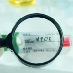 Mpox acende alerta no Brasil: como o vírus se espalha, quais os sintomas e quando buscar ajuda