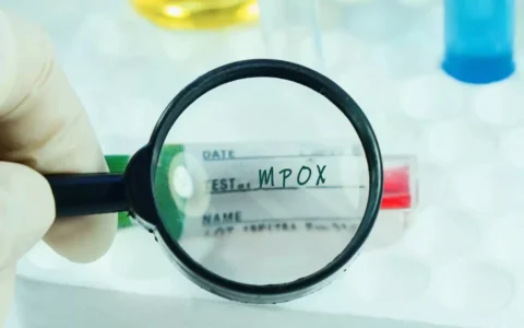 Imagem do post Mpox acende alerta no Brasil: como o vírus se espalha, quais os sintomas e quando buscar ajuda