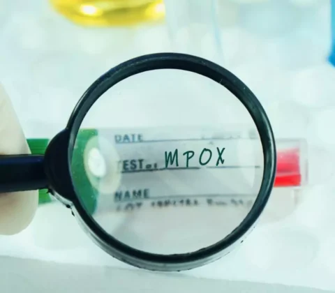 Imagem do post Mpox acende alerta no Brasil: como o vírus se espalha, quais os sintomas e quando buscar ajuda