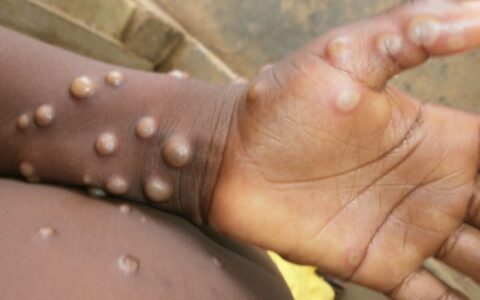 Imagem do post Mpox avança no Brasil: país chega a 90 casos e dois novos estados entram na lista