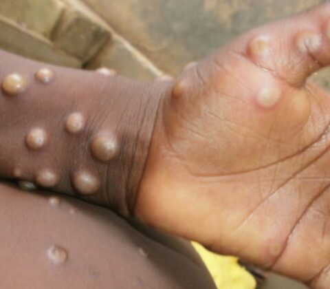 Imagem do post Mpox avança no Brasil: país chega a 90 casos e dois novos estados entram na lista