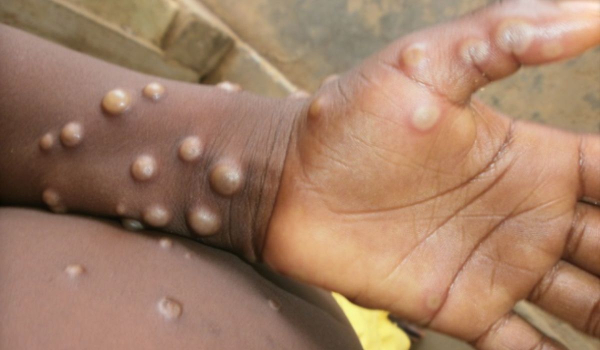 Mpox avança no Brasil: país chega a 90 casos e dois novos estados entram na lista