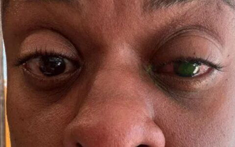 Imagem do post Atriz Cacau Protásio perde visão após usar pomada de cabelo e faz alerta