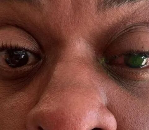 Imagem do post Atriz Cacau Protásio perde visão após usar pomada de cabelo e faz alerta