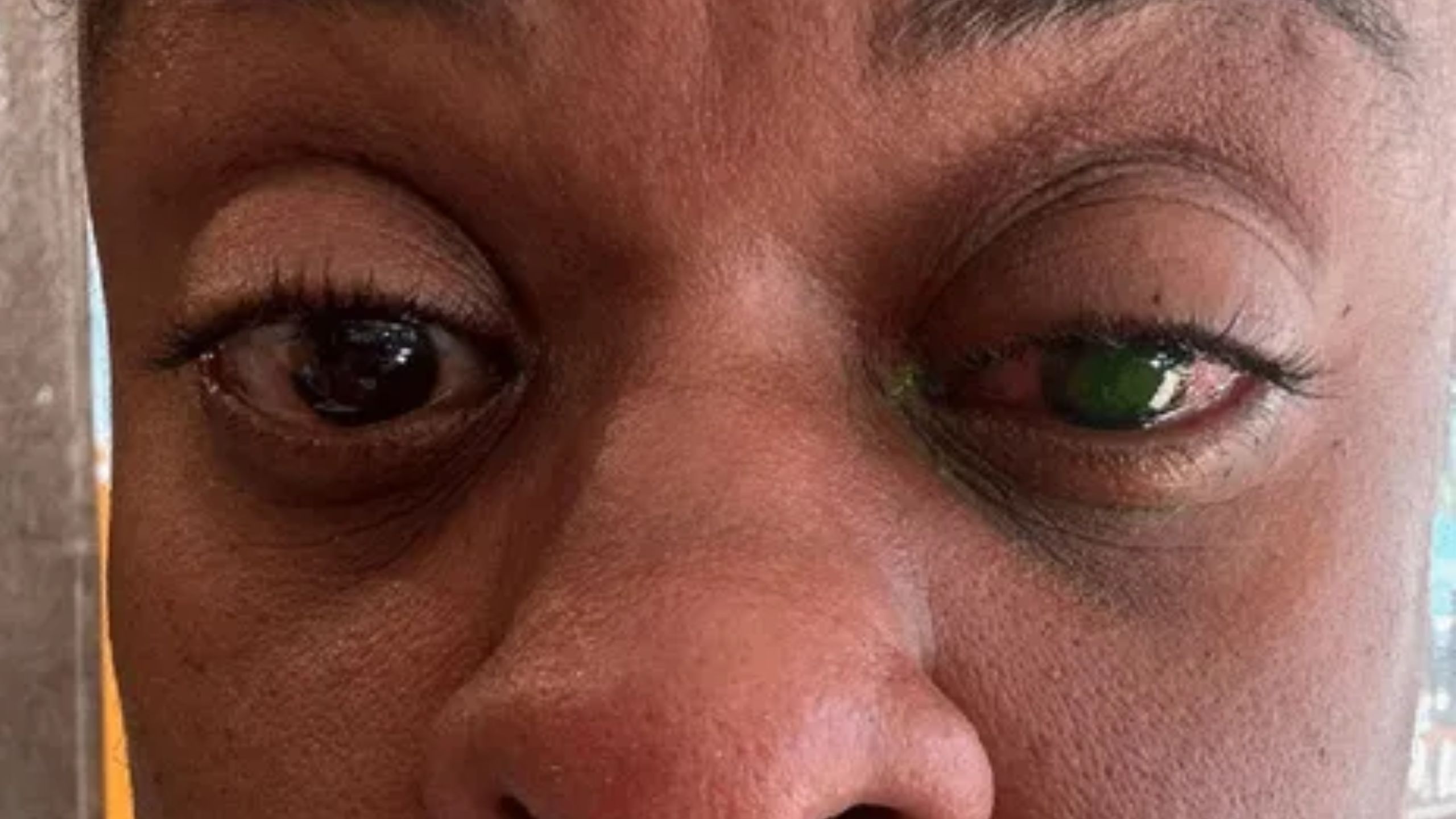 Atriz Cacau Protásio perde visão após usar pomada de cabelo e faz alerta