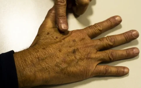 Imagem do post Desinformação sobre câncer de pele afeta diagnóstico, diz instituição