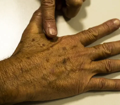 Imagem do post Desinformação sobre câncer de pele afeta diagnóstico, diz instituição