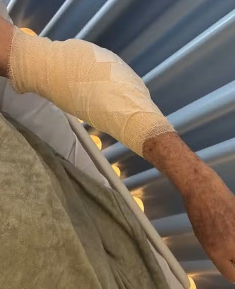 Idoso é atacado por pitbull em Stella Maris; ferimento exigiu cirurgia
